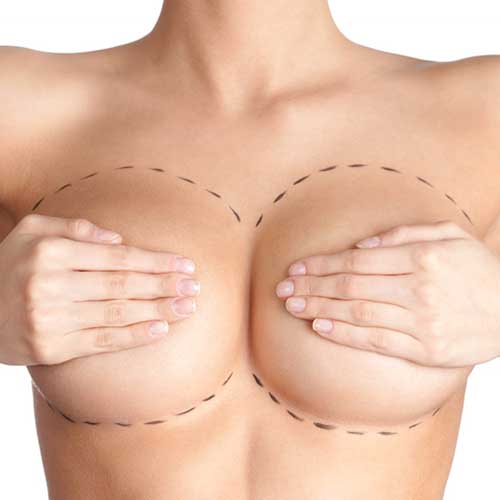 a implante de senos, implantes mamarios, levantamiento de senos. Antes de someterse a una cirugía de implantes mamarios, la paciente debe estar bien informada sobre el tipo de cirugía que le realizarán, la manera como se la harán
