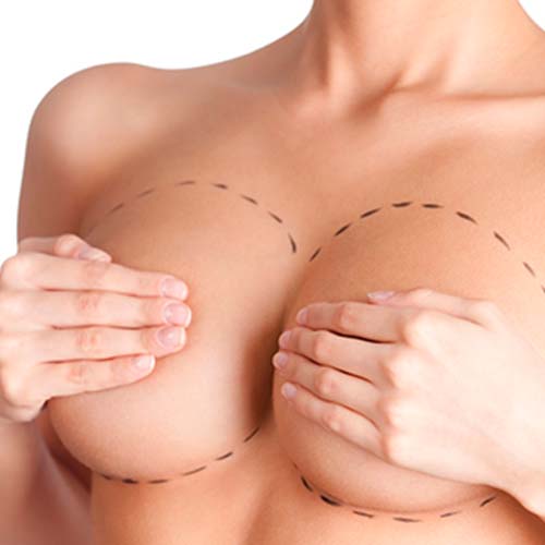 El aumento de mamas exige una cuidadosa evaluación de la morfología mamaria y de la anatomía de la pared torácica. Esta técnica consiste en realizar una incisión en todo el borde de la areola. El objetivo principal de esta técnica es hacer la incisión entre la parte oscura de la areola. Cirugia. Una de las cirugias más pedidas. Cirugía mw estética. Cirugías mamarias. Operación de mamas. Protesis mamarias. Implantes.